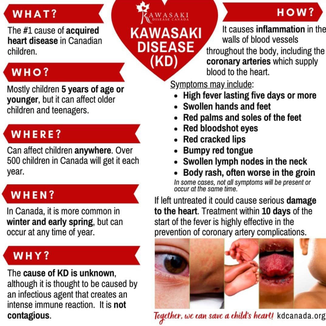 Kawasaki disease symptoms
