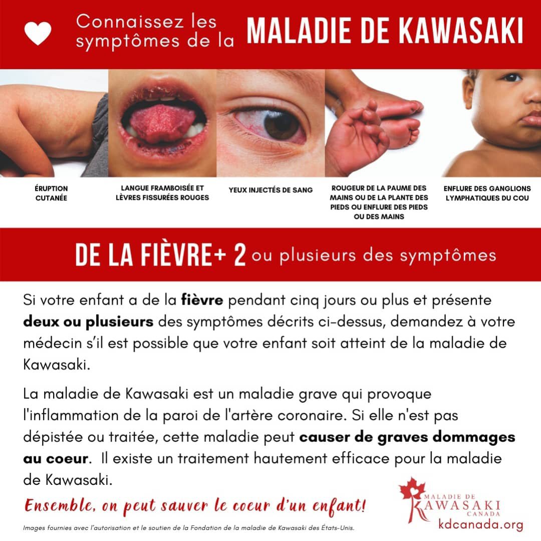 Maladie de Kawasaki